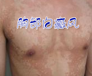 胸部白癜風疾病的癥狀有哪些